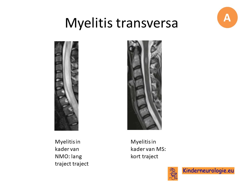 mri myelitis